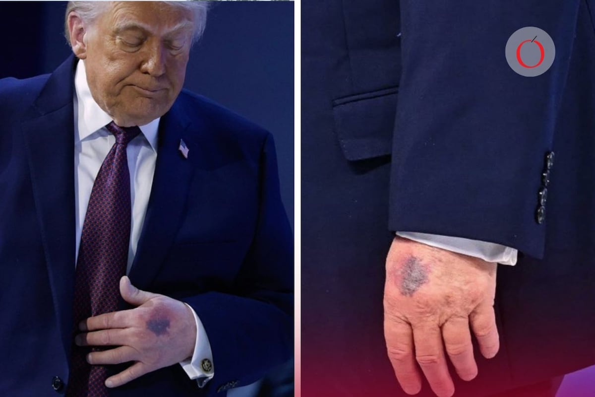 El misterio detrás del golpe: la Casa Blanca revela los detalles sobre la lesión que deja fuera de combate al Presidente de EE.UU.